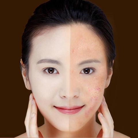 Blue Light Acne Treatment